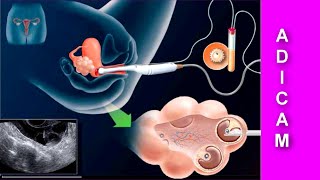 Herencia y Cáncer de Mama Aspectos reproductivos [upl. by Htidirrem366]