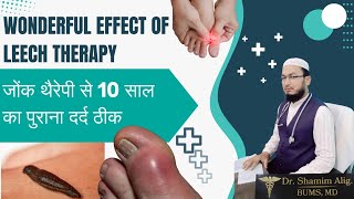 How to Manage Gout Pain The Complete Guide leechtherapy [upl. by Koressa872]