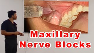 Maxillary Nerve Blocks Lecture  Dr Zibran Khan [upl. by Paulson]