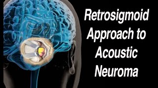 Retrosigmoid or Suboccipital Approach to Acoustic Neuroma Surgical Removal [upl. by Grefe]