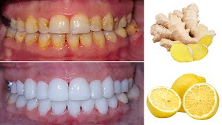 Mix ginger with lemon and your teeth will look like pearls teeth whitening at home [upl. by Egdirdle]