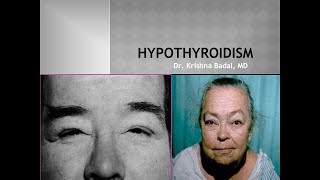 Hypothyroidism Myxedema [upl. by Richie]