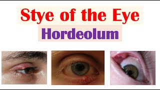 Eye Stye Hordeolum  Causes Symptoms Diagnosis amp At Home Treatments [upl. by Dredi]