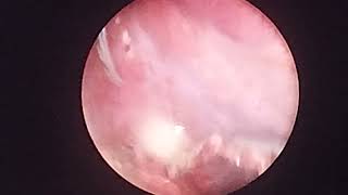 laparoscopic appendectomy in appendicular lump [upl. by Nogaem]