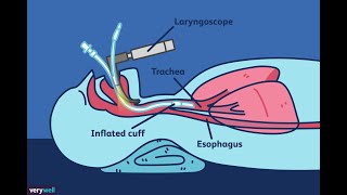 Intubation difficile  Live démonstration  AIRWAY [upl. by Chatwin122]