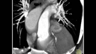 4D Imaging of the Aortic Valve Dilated aortic root 2 of 6 [upl. by Anirac424]