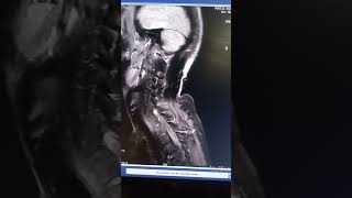 CEMRI BRACHIAL PLEXUS SEQUENCE [upl. by Odnavres]