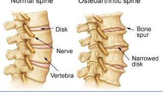 Anatomy of Spinal Arthritis Explained by Top Pain Doctor in Las Vegas Nevada [upl. by Adliwa]