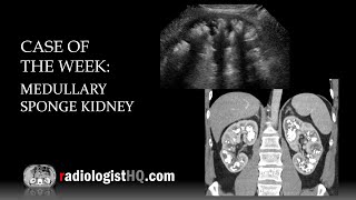 Case of the Week Medullary Sponge Kidney Ultrasound amp CT [upl. by Ydnagrub]