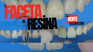 Faceta de Resina Composta em Dente Escurecido [upl. by Atnauqahs]