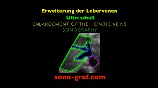 Sonographie  Erweiterung der Lebervenen [upl. by Sungam]