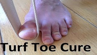 Turf Toe Treatment 1 Min Home Remedy [upl. by Moshe]