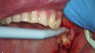 TOOTH ABSCESS PUS DRAINAGE THROUGH EXTRACTION SOCKET [upl. by Mohammed]