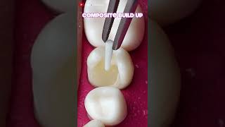 Onlay Teeth Restoration dentistteeth satisfying [upl. by Amelia]