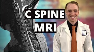 Neurologist Reviews Cervical Spine MRI Multiple Sclerosis with Enhancing Lesions [upl. by Oca108]