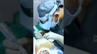 Viral Hair Transplant Surgery at Cara Clinic [upl. by Keiryt]