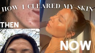 HOW I CLEARED MY SKIN IN 5 WEEKS hormonal acne [upl. by Ebocaj]