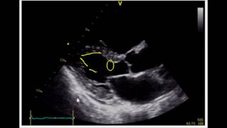 Estimating Ejection Fraction with Point of Care Echo [upl. by Serles477]