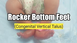 Congenital Vertical Talus [upl. by Florentia]