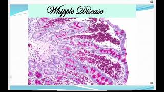 Malabsorption syndrome lecture 2 part 2 [upl. by Ativahs]