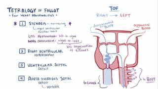 Tetralogy of fallot TOF repair causes symptoms amp pathology [upl. by Candace457]