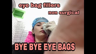 eye bag fillers non surgical eye bag removal [upl. by Bethany796]