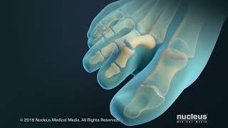 Andrew Podiatrist gets an injection for his Hallux limitus [upl. by Adnirol]