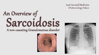 Sarcoidosis  A Quick and Easy Overview for revision [upl. by Igig225]