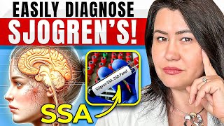 How to Diagnose Sjogrens Disease [upl. by Aita16]