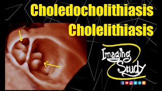 Cholelithiasis II  Gastroenterology Medicine Animation  Medical VLearning [upl. by Auqeenahs]