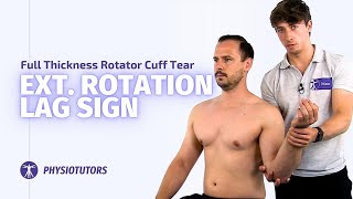 External Rotation Lag Sign  Full Thickness Rotator Cuff Tears [upl. by Cleland]