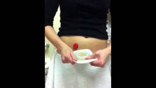 Ostomy pouch change using ConvaTec moldable [upl. by Zubkoff709]