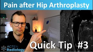 Pain after hip arthroplasty on MRI  a subtle finding MSKrad quick tip 3 SHORTS [upl. by Aneeroc]