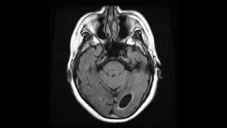 Periventricular leukomalacia Axial T2 FLAIR [upl. by Argyle144]