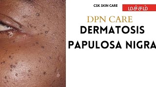 CSKIN உணர்வோம் DERMATOSIS PAPULOSA NIGRA TAMIL DPN NATURAL CARE மச்சம் MOLESKINTAG NATURAL CARE [upl. by Carolin740]