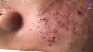 BLACKHEADS REMOVAL on face  how to get rid of blackheads amp whiteheads series acne treatment 0200 [upl. by Loginov77]