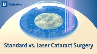 Standard vs Laser Cataract Surgery  Duke Health [upl. by Ahsimet921]