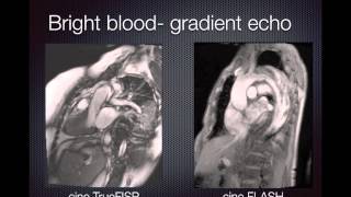 Cardiac MRI Pulse sequences [upl. by Osgood668]