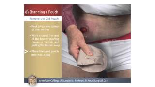 ColostomyIleostomy Changing a Pouch [upl. by Nazarius114]