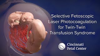 TwinTwin Transfusion Medical Animation TTTS  Cincinnati Fetal Center [upl. by Ettenauq328]