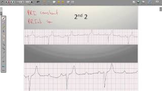 ECG Heart Blocks [upl. by Ullund]