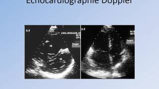 CARDIOLOGIE CAT devant une Embolie Pulmonaire [upl. by Akimal]