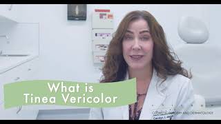 Tinea Versicolor How to Treat [upl. by Ransome]