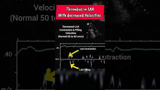 Low Velocities and Thrombus in LAA of Heart ♥ echocardiography [upl. by Deraj]