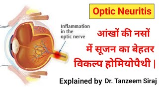 Optic Neuritis Symptoms amp Causes आंखों की नसों में सूजन का होम्योपैथिक उपचार Optic Neuritis [upl. by Jenifer]