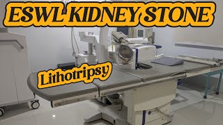 Kidney Stone Lithotripsy  Laser treatment  ESWL Lothtripsy  Extrcorporeal Shock Wave Lithotripsy [upl. by Ambler]