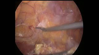 laparoscopic Right lumber incisional hernia [upl. by Etnahsal719]