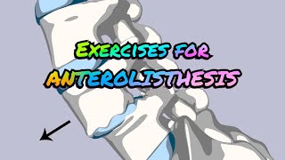 Exercises for ANTEROLISTHESIS [upl. by Alvina]