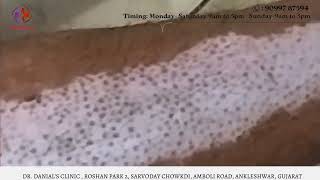 Vitiligo 2Month Treatment Transformation  White spot Treatment in Hindi  Dr Danials Clinic [upl. by Aneehsat442]