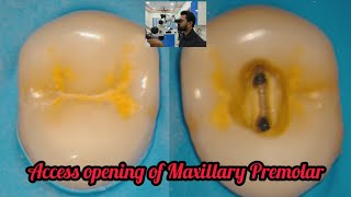 Access opening of Maxillary Premolar step by step root canal demonstrationrct for beginners [upl. by Lanford]